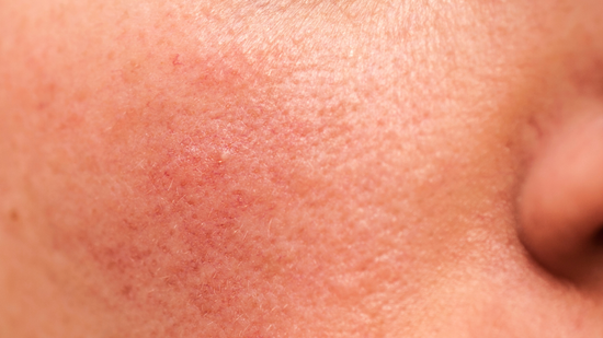 Peau sensible en hiver : comment apaiser les rougeurs, tiraillements et inconforts